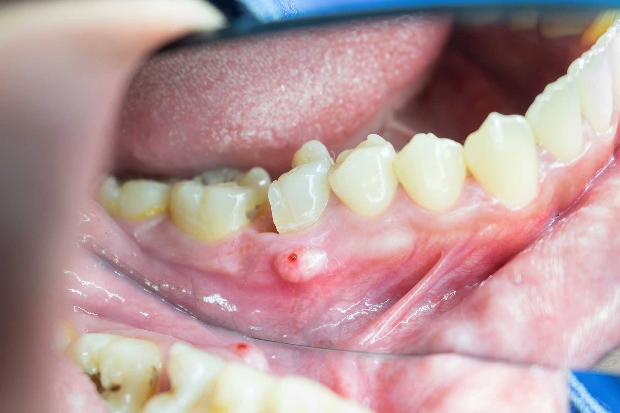 Close up of someone’s mouth showing an abscessed tooth