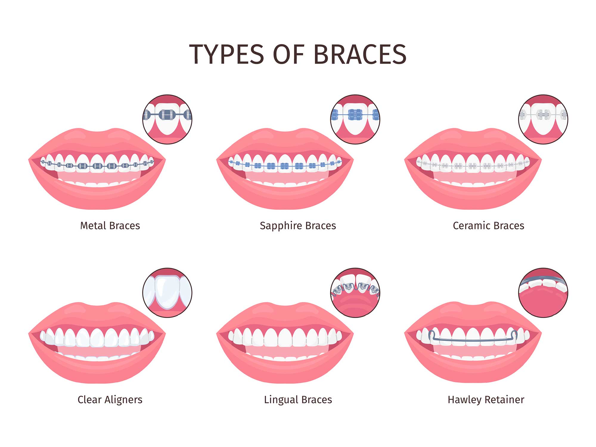 An illustration showing six types of braces: metal, sapphire, ceramic, clear, lingual and hawley