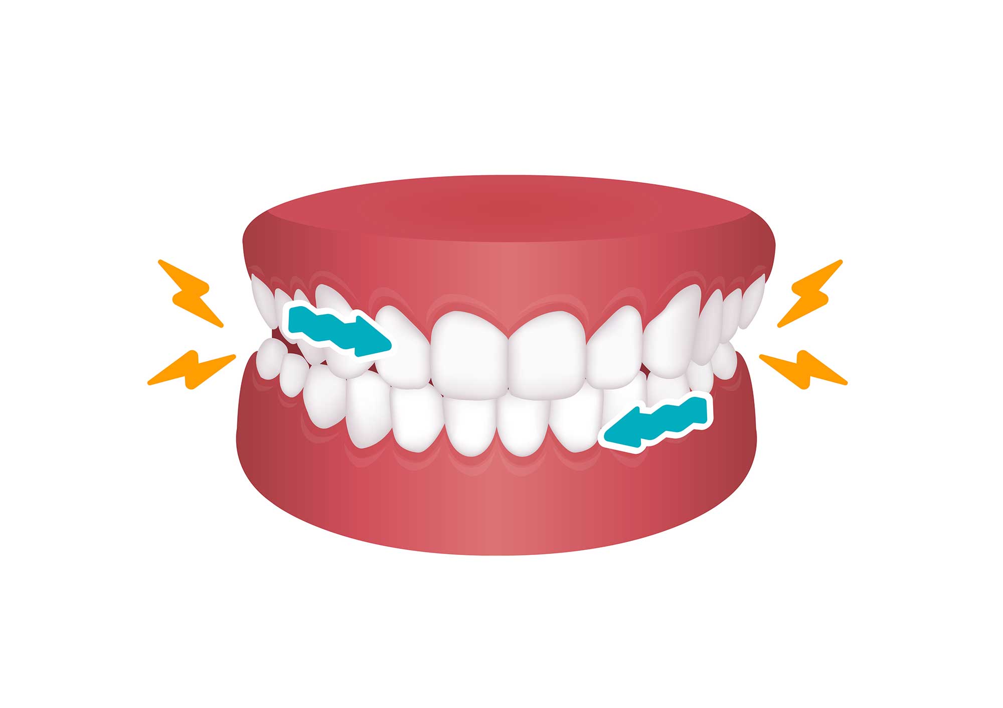 Illustration of a set of teeth showing how teeth grinding happens Illustration of a set of teeth showing how teeth grinding happens