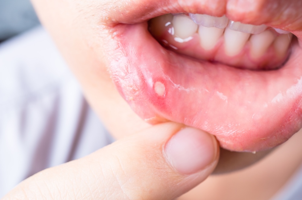 Close-up of mouth with canker sore on their inside lip