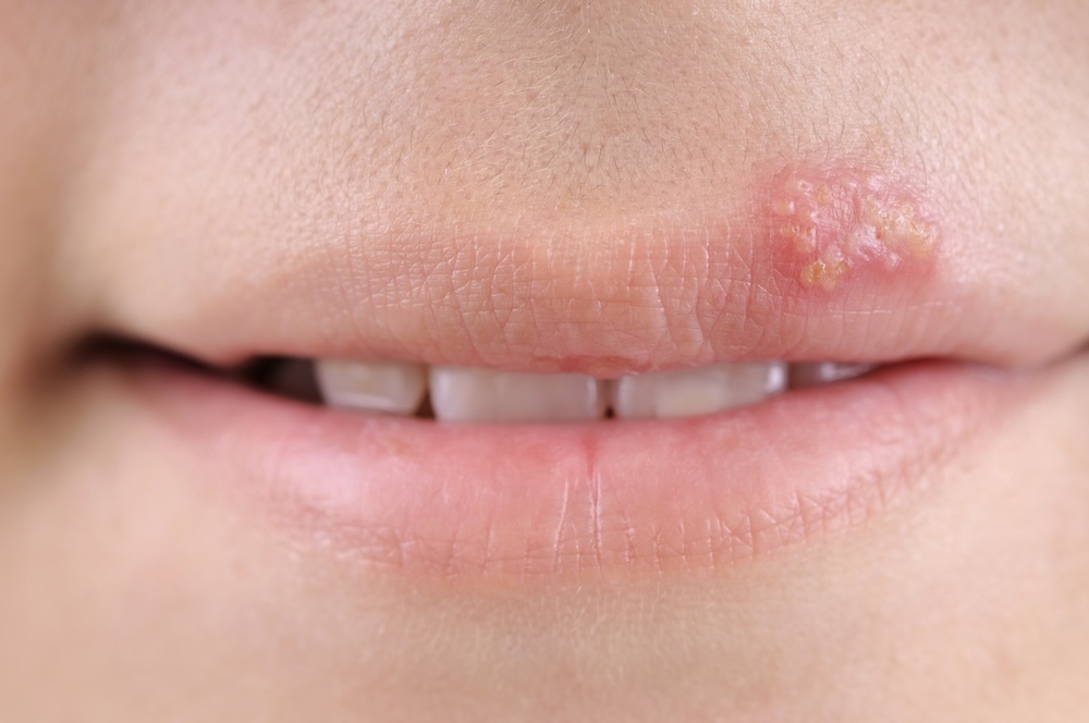 Cold sores are oral lesions found around the lips