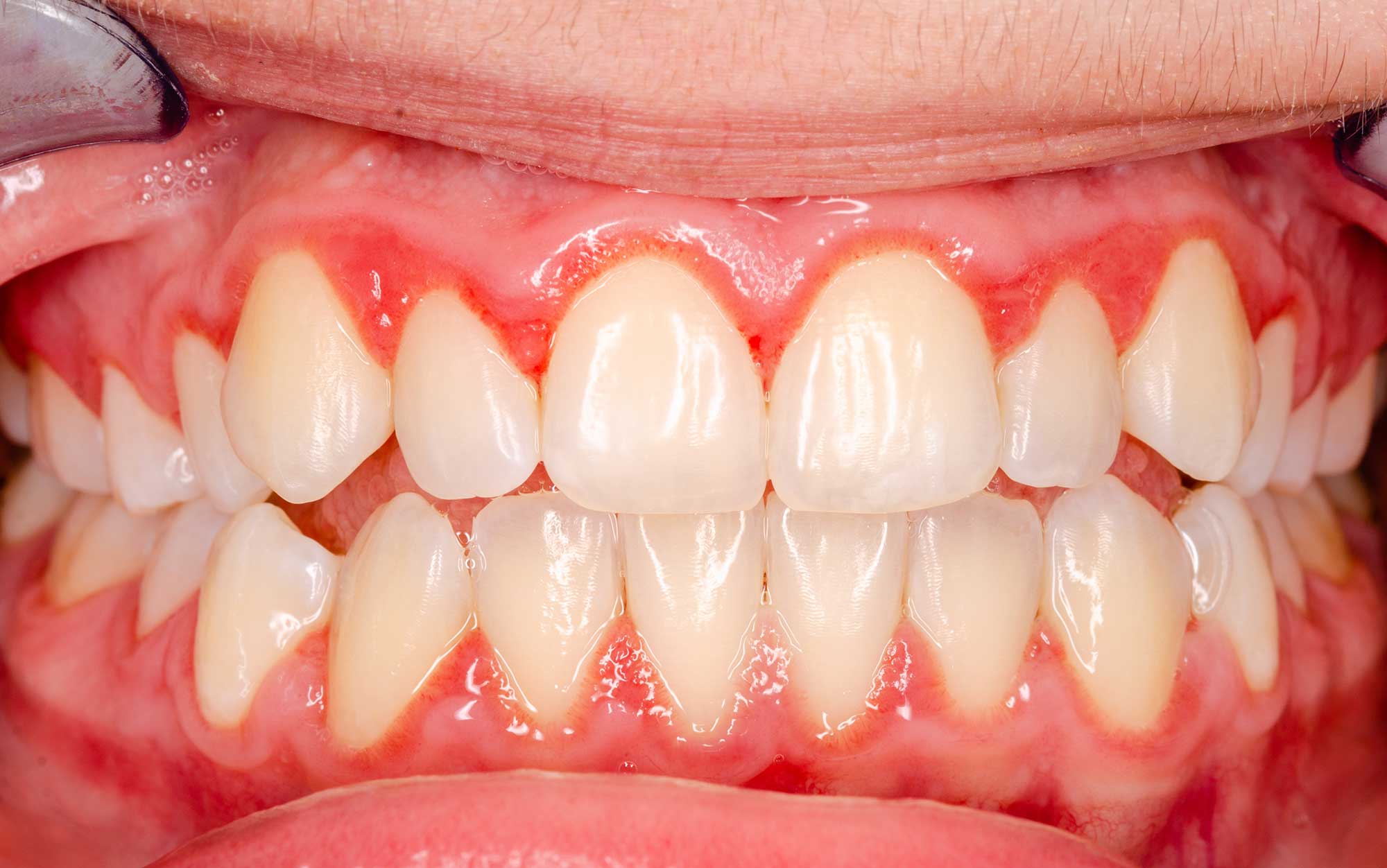 Close up grimacing teeth with bleeding gums