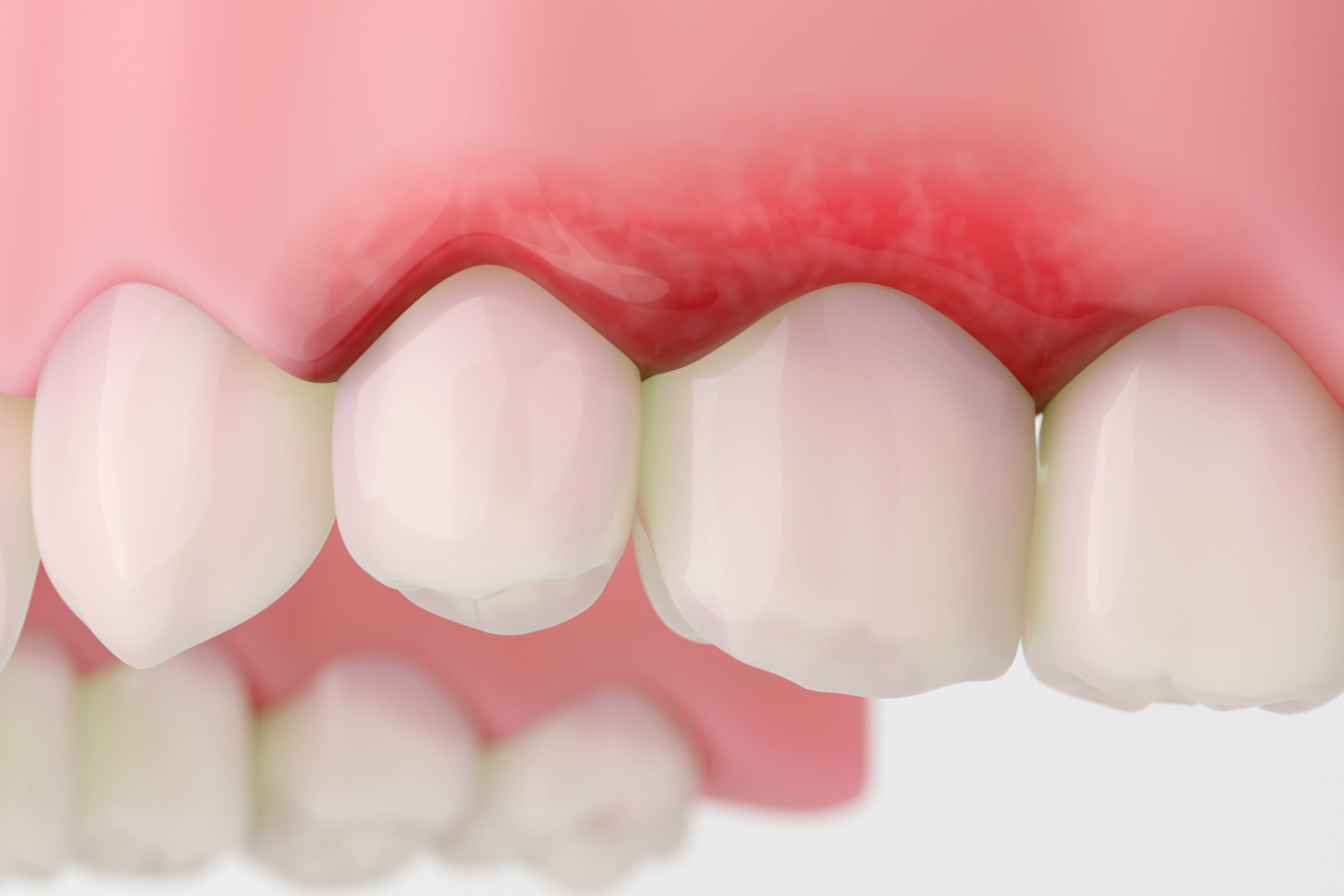 Receding Gums: Causes, Symptoms, and Treatments