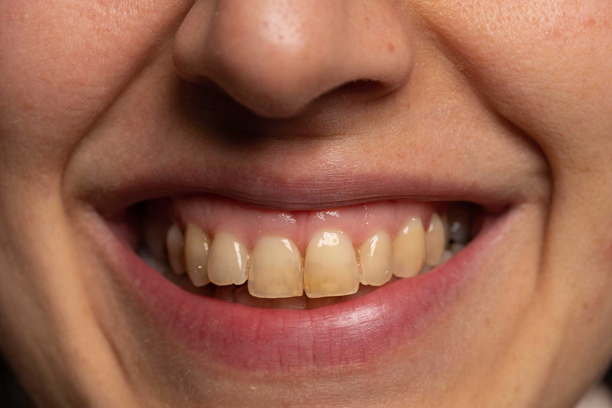 Close up of someone smiling, showing their yellow stained teeth Banner Image Close up of someone smiling, showing their yellow stained teeth