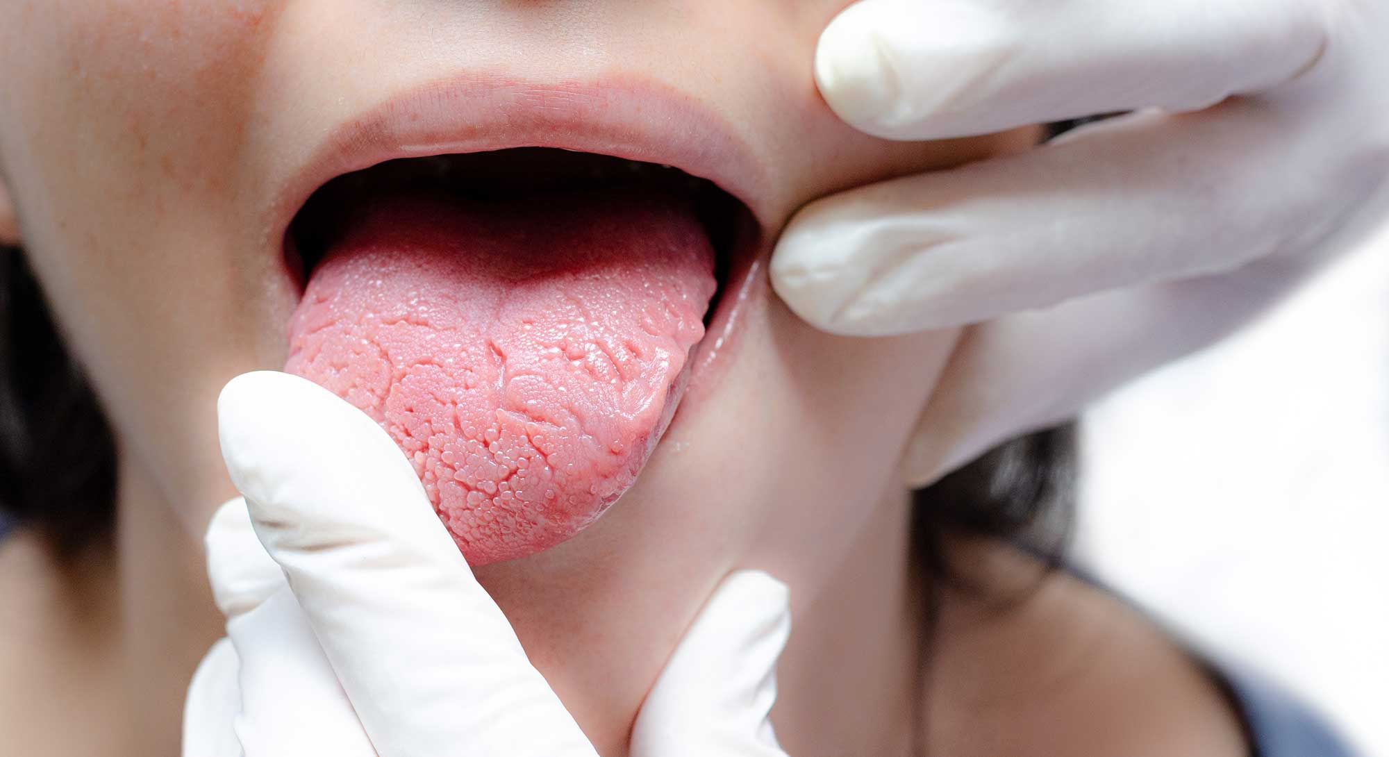 Close-up of tongue being examined by medical professional