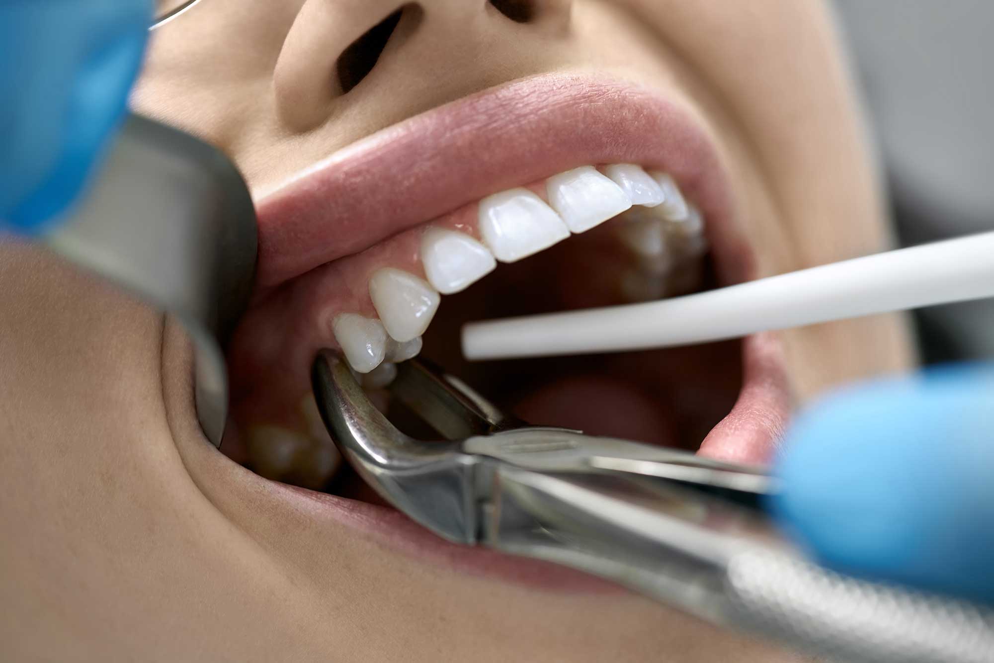 Close-up of tooth extraction procedure in a dentist’s office
