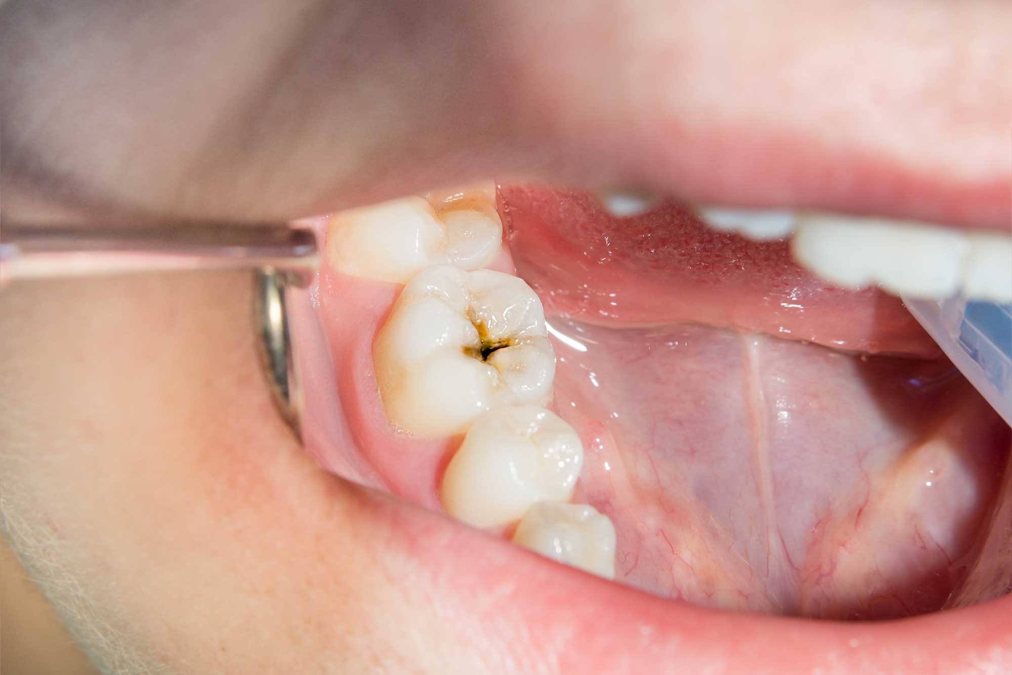 Close up of tooth with cavity being examined at a dentist’s office