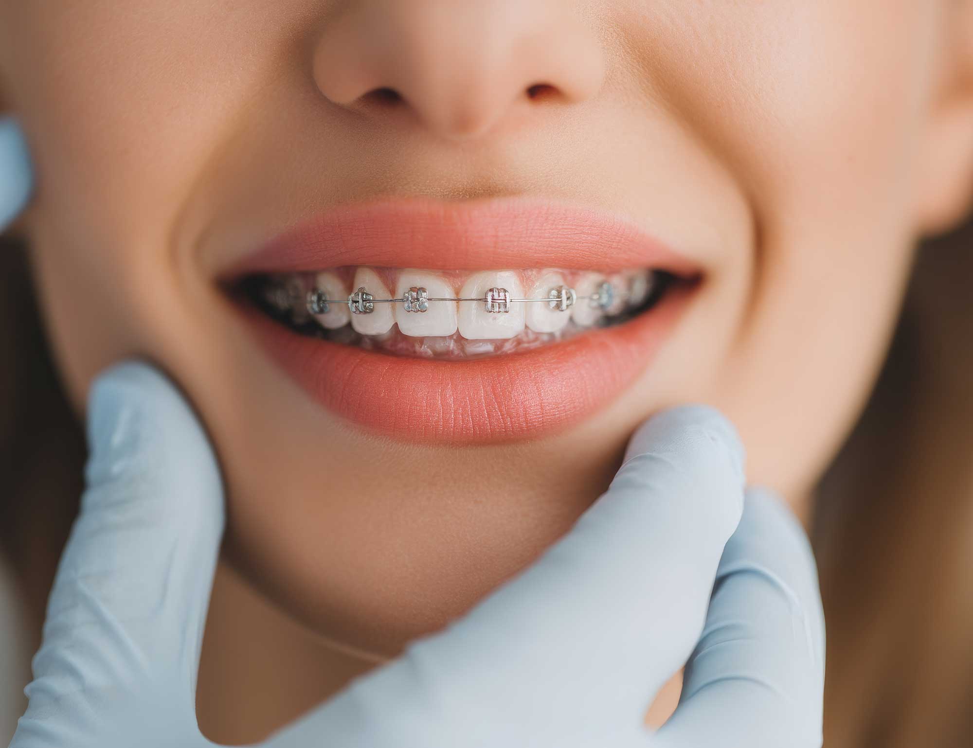 Close-up of woman with braces on her teeth image
