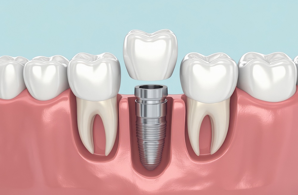 Cross-section showing an implant installed into the gums with a crown on top Banner Image Cross-section showing an implant installed into the gums with a crown on top