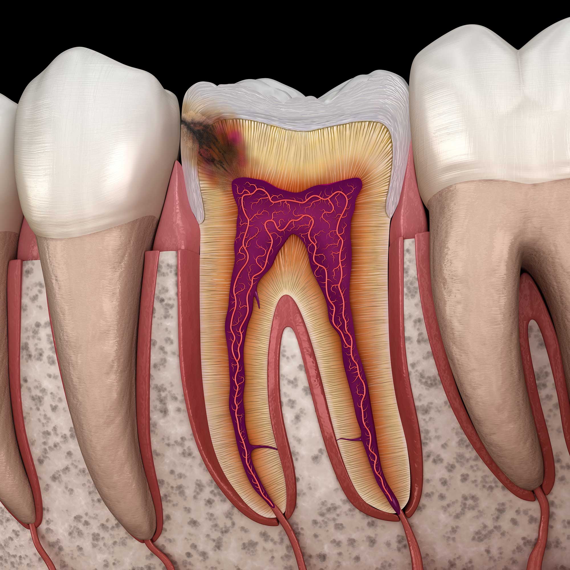 Cross-sectional diagram showing a cavity forming on the side of a tooth