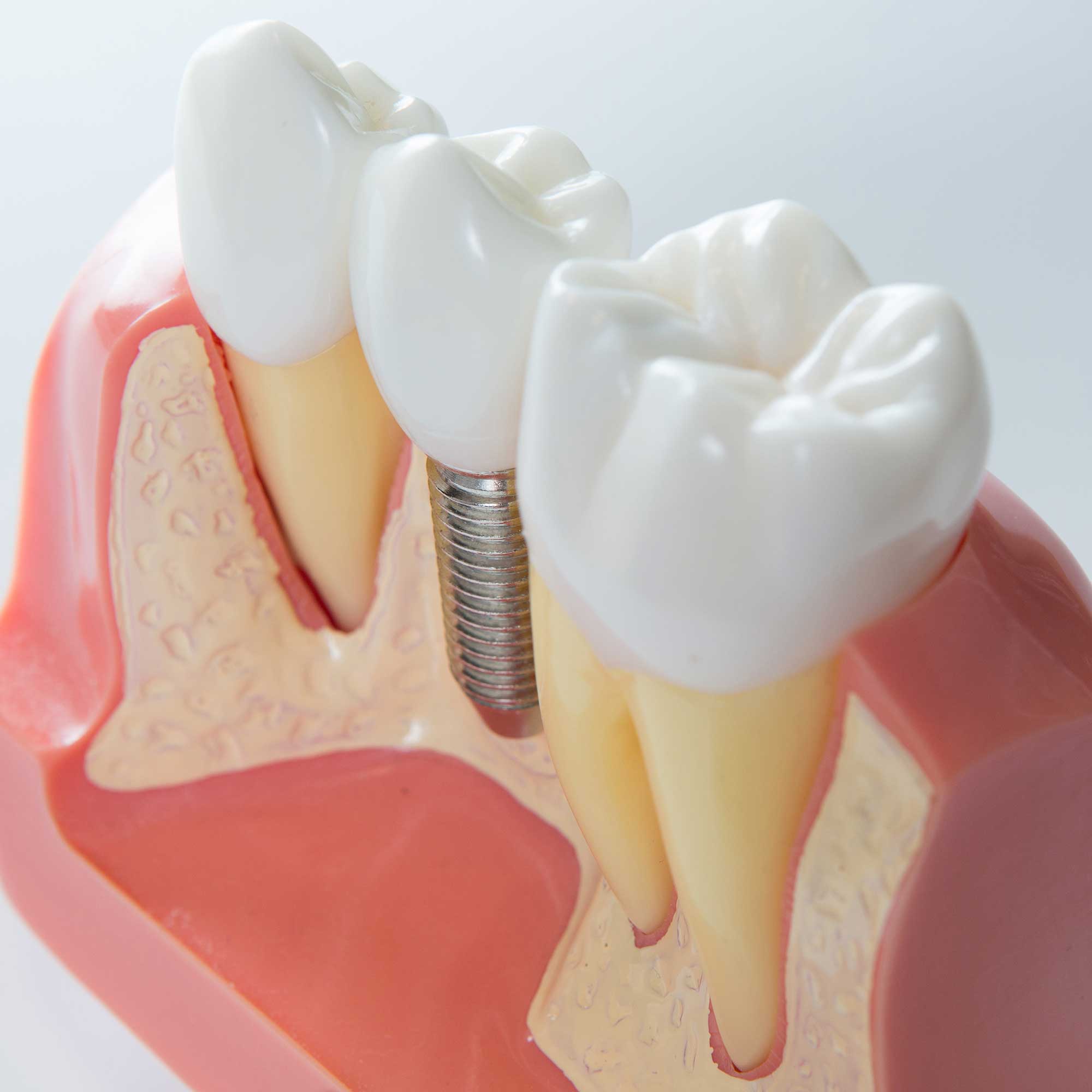  Cross-sectional model showing a dental implant screwed into the gums 