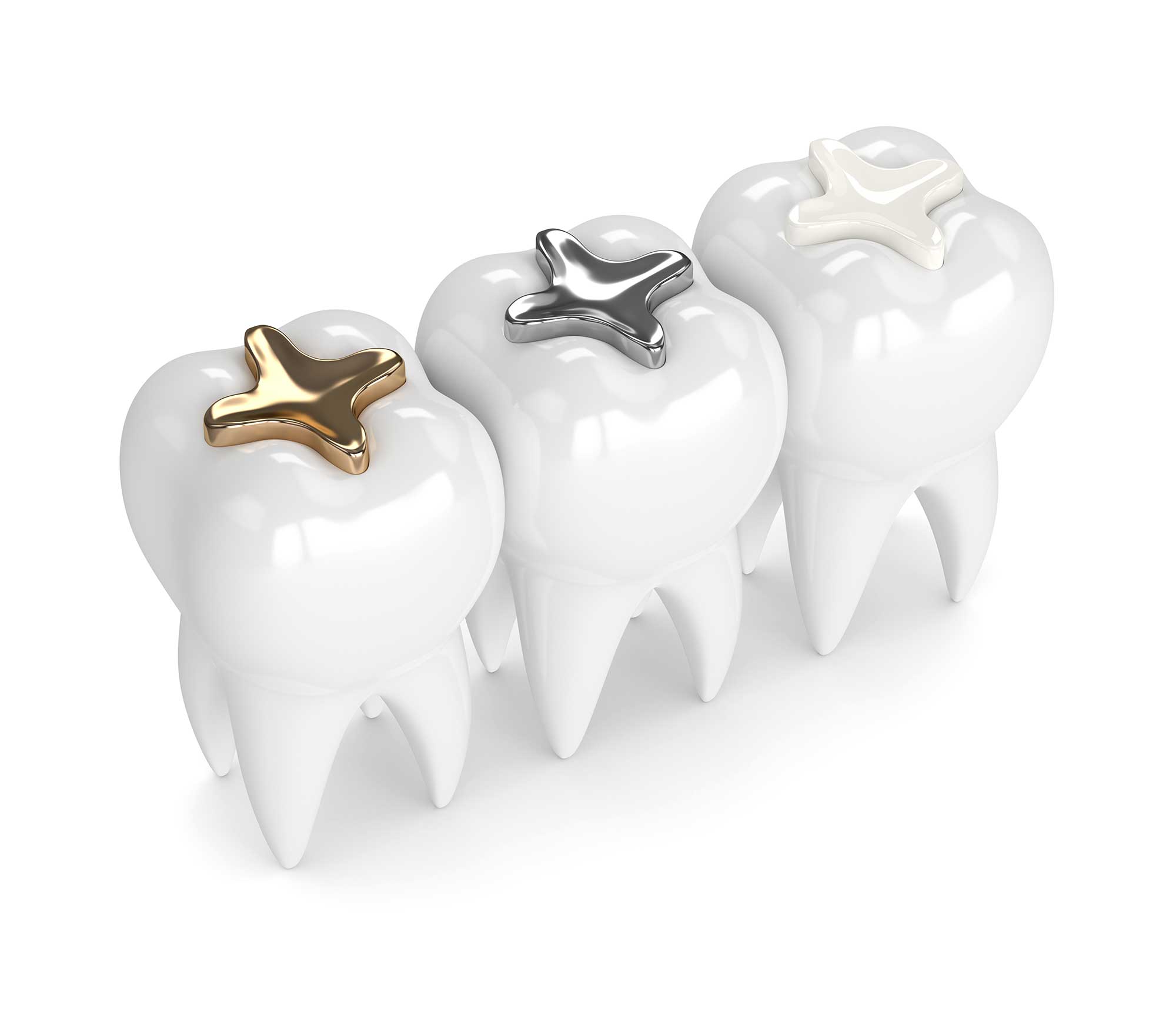 Model of molars showing different types of cavity fillings Model of molars showing different types of cavity fillings