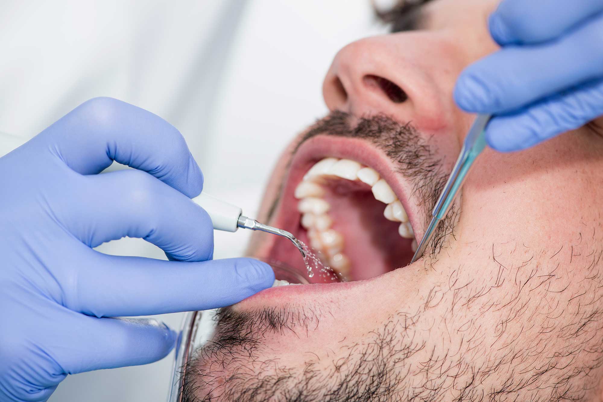 Dental plaque removal procedure