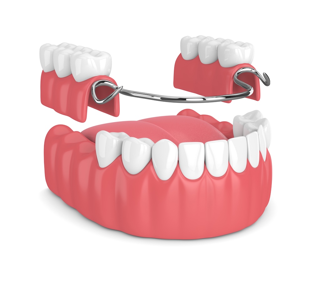 Display of partial dentures and how to insert them image