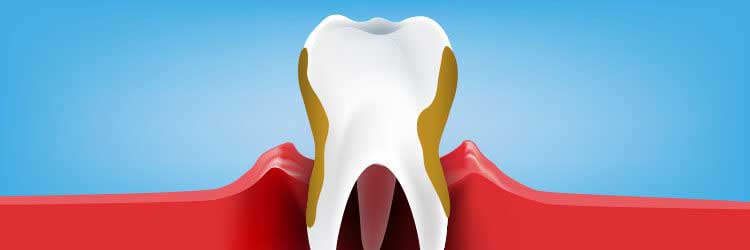 Periodontitis: Causes, Symptoms, and Treatments