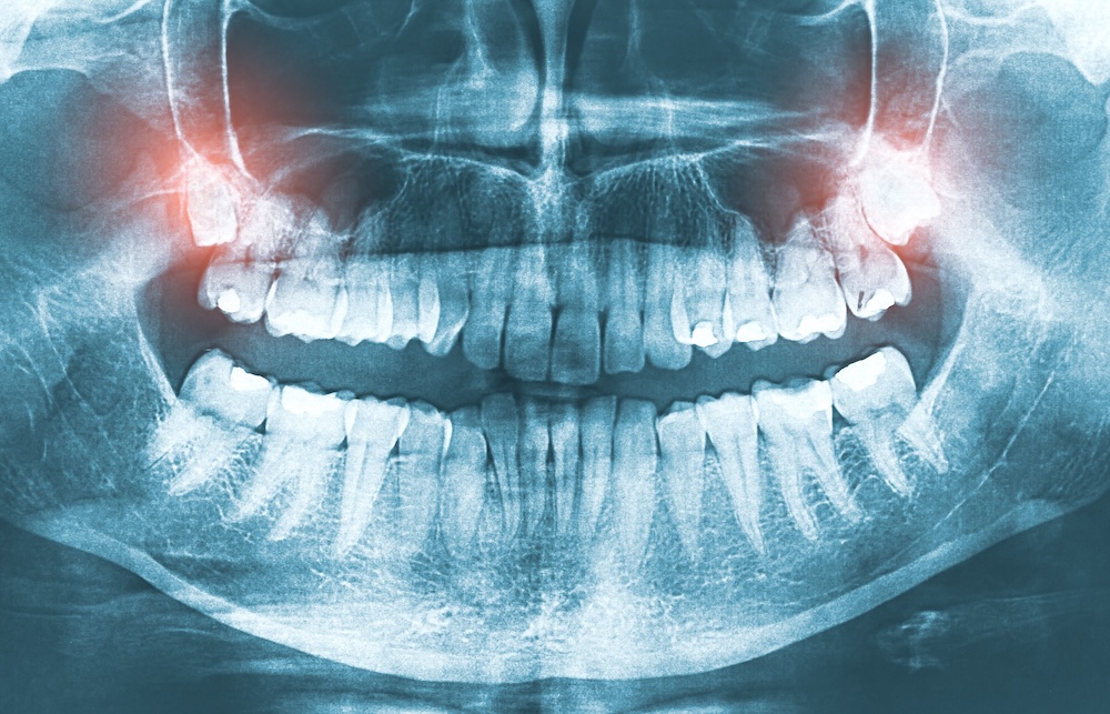X-ray showing a patient’s full set of teeth X-ray showing a patient’s full set of teeth
