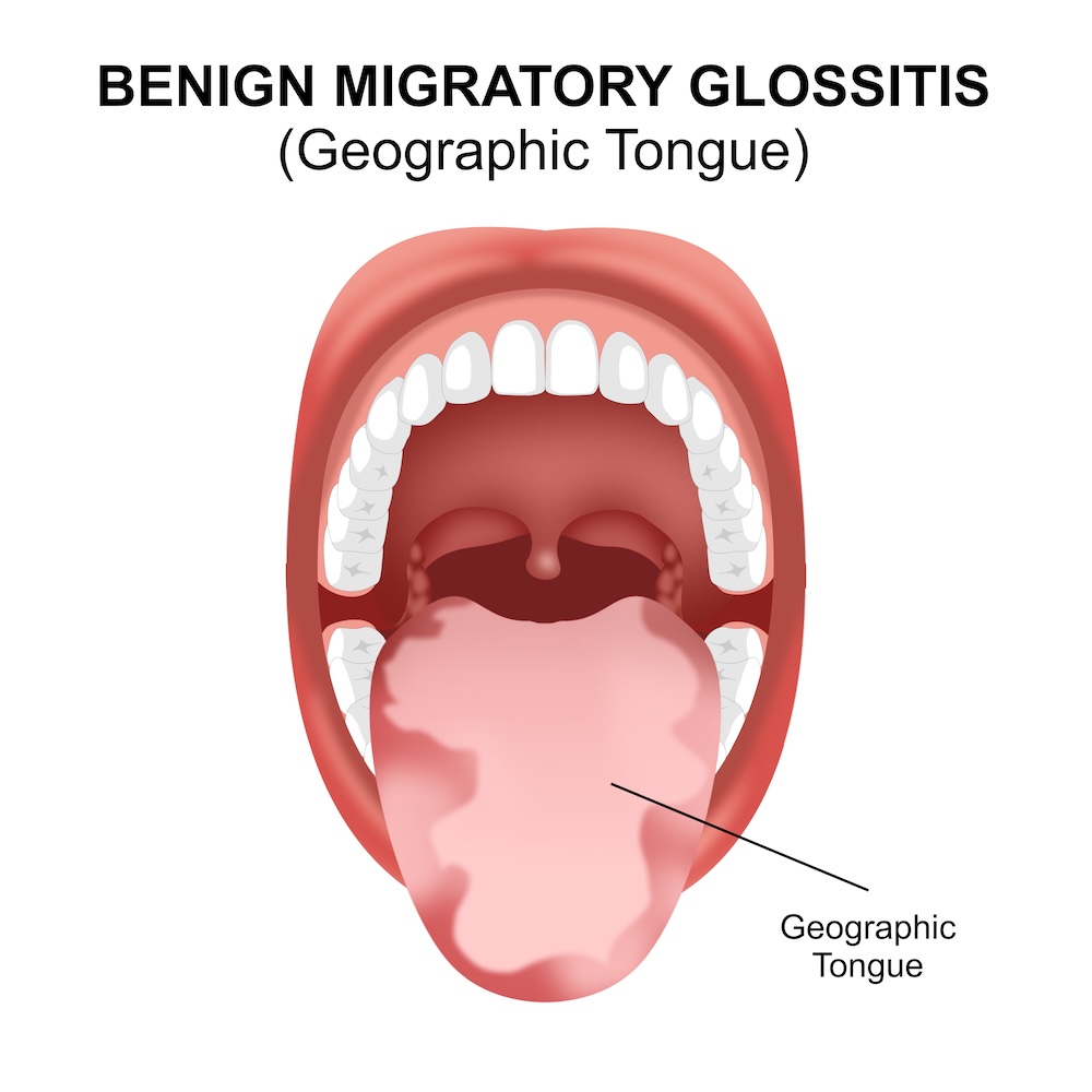 Illustration of geographic tongue image