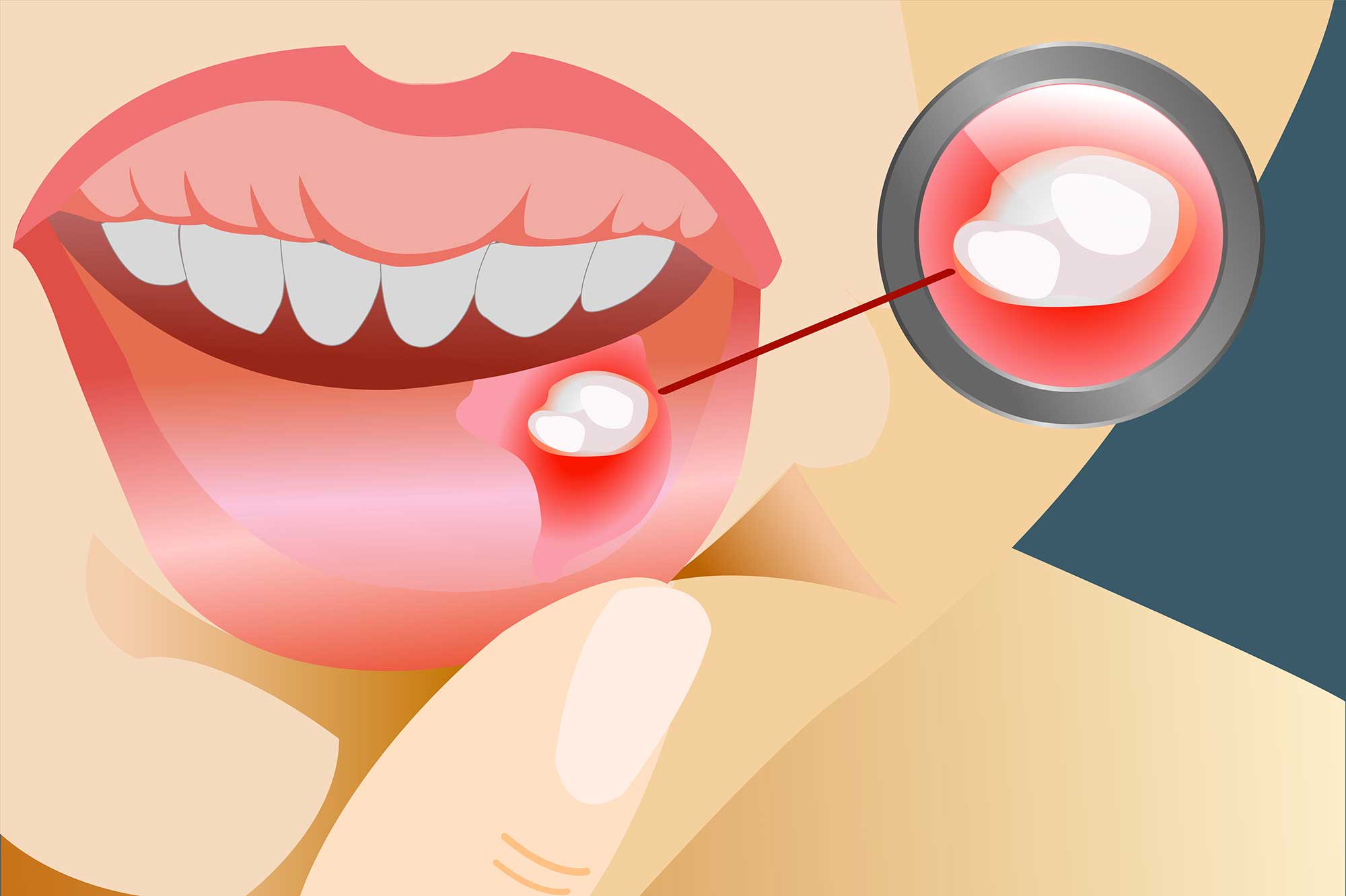  Illustration showing the formation of a canker sore inside the lower lip 
