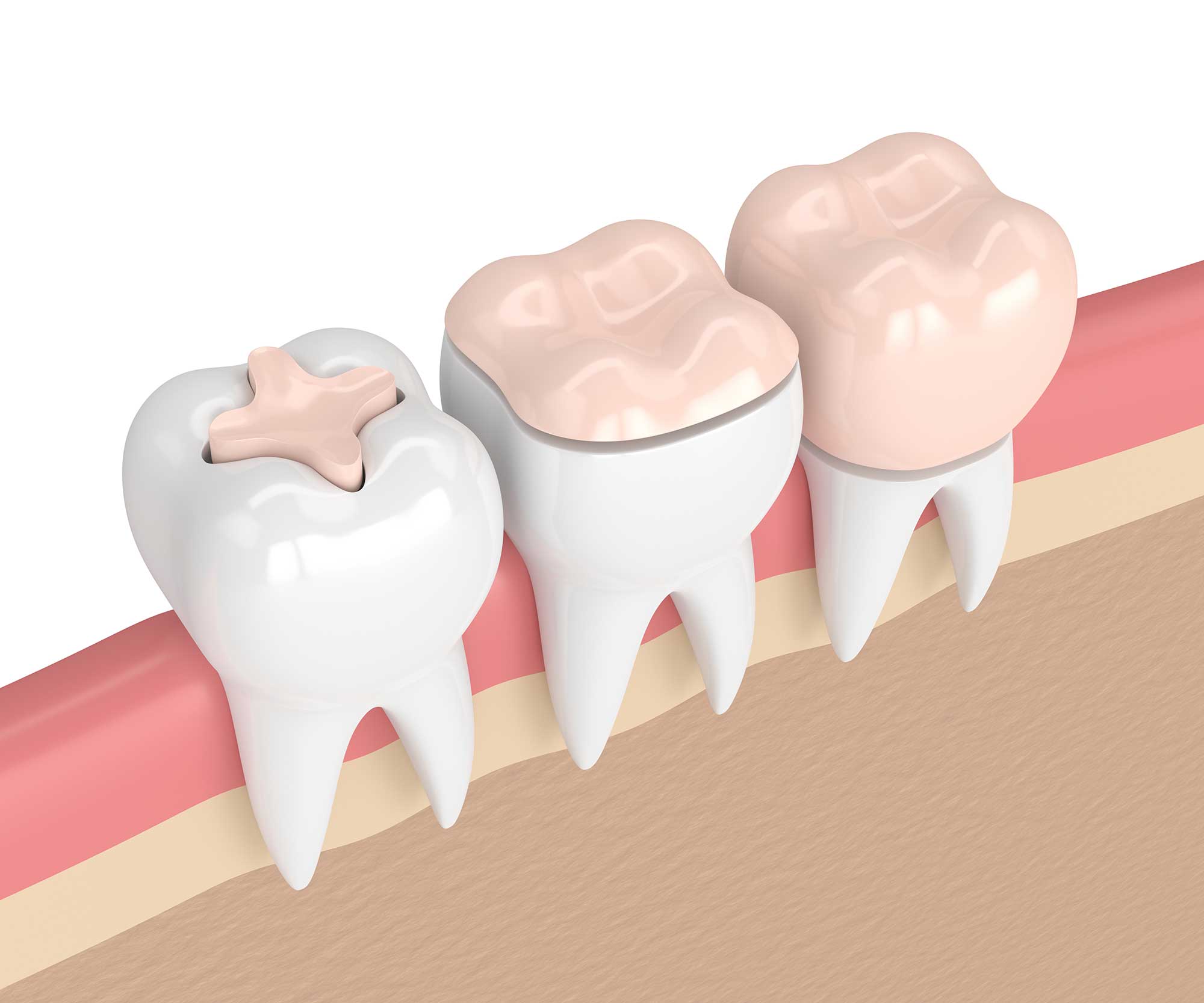 Illustration of three teeth showing different dental restorations: the first tooth has an inlay, the second tooth has an onlay, and the third tooth is covered with a crown. The image is a cross-section of teeth embedded in gums.