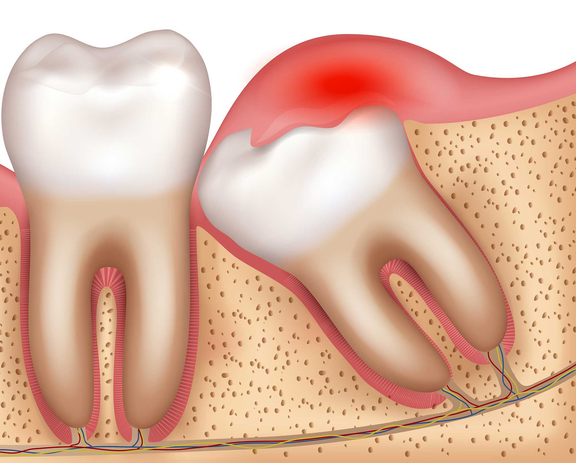 Illustration showing a tooth growing in and pushing into another tooth