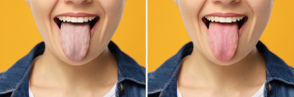 Side-by-side comparison showing an unhealthy tongue next a healthy one