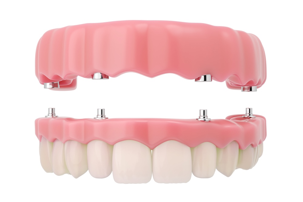 Plastic model of top teeth showing how dental implants are inserted with screws image