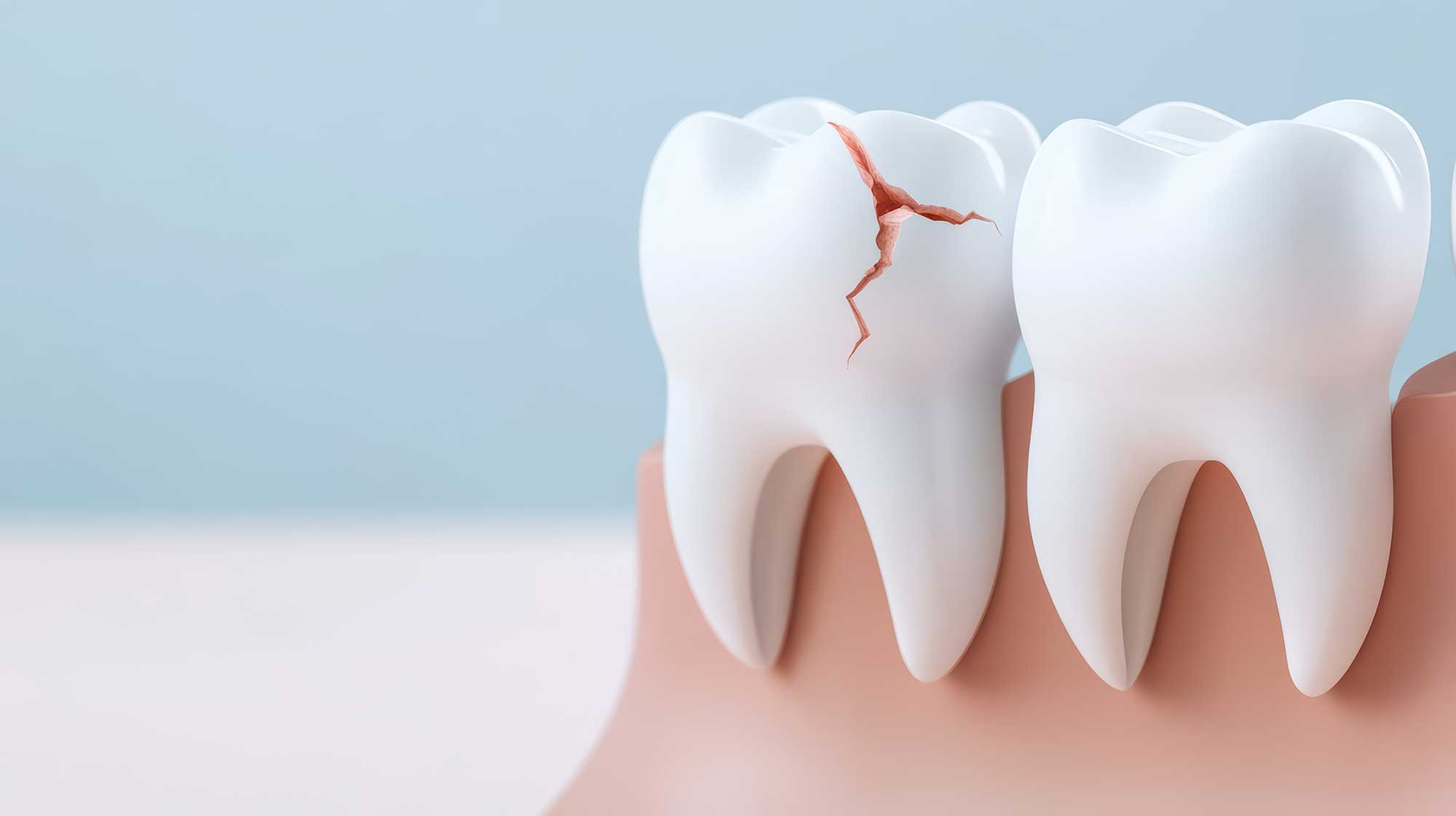 Model of teeth showing a crack in one tooth