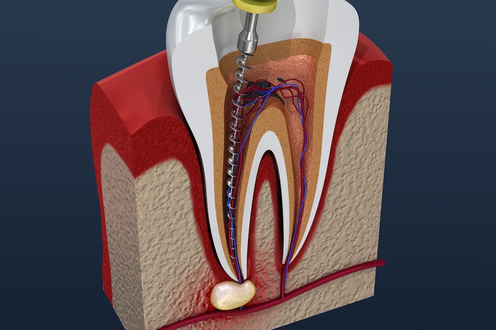 Cross-sectional model of root canal procedure