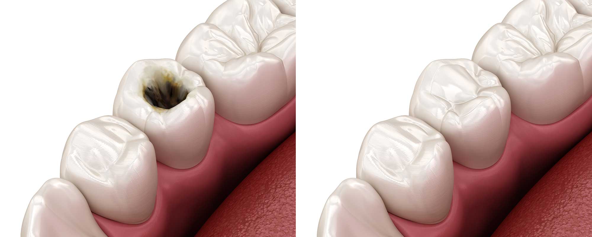 Side by side showing molars with cavities versus molars without