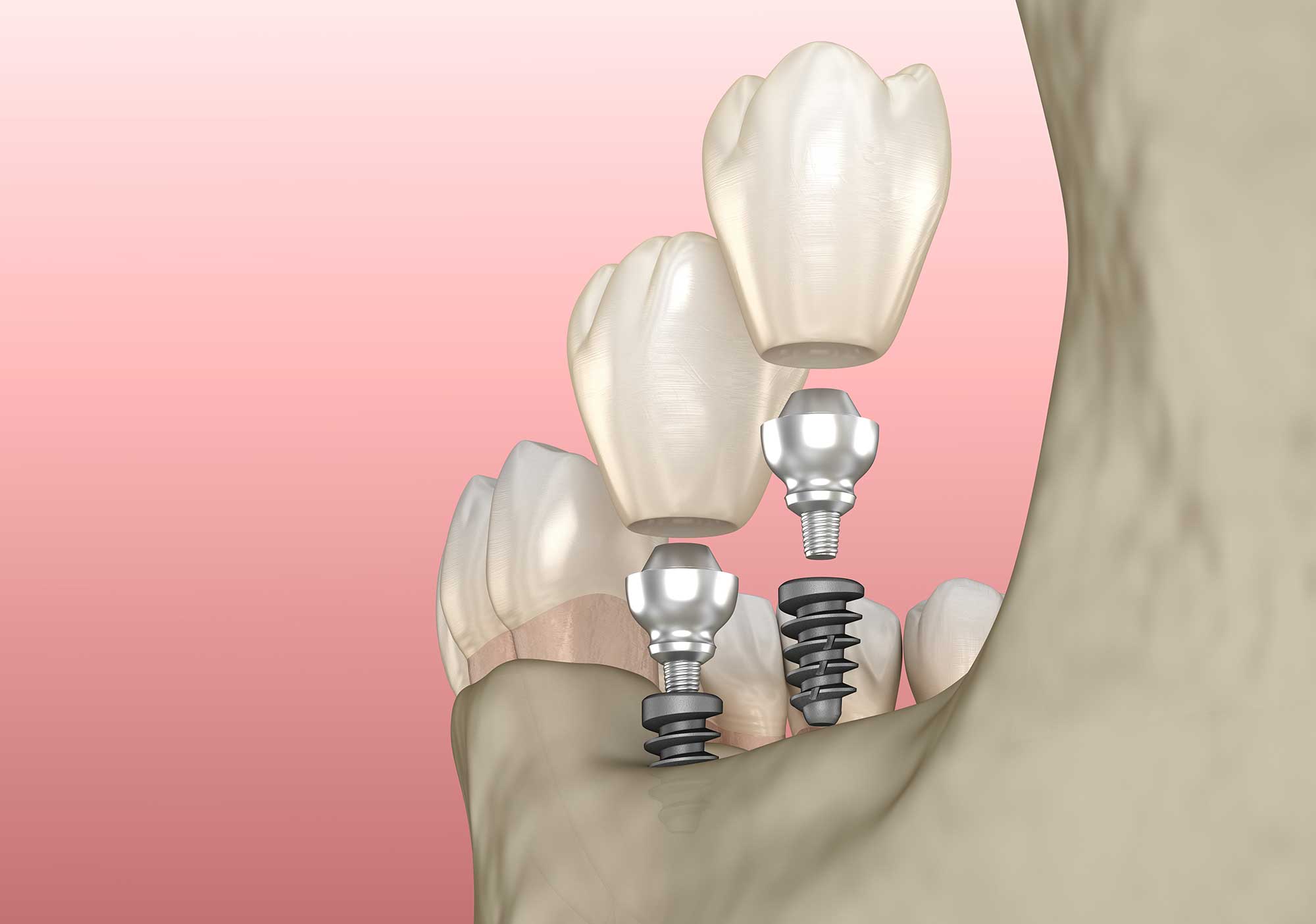 Stylized illustration showing the steps to install a dental implant