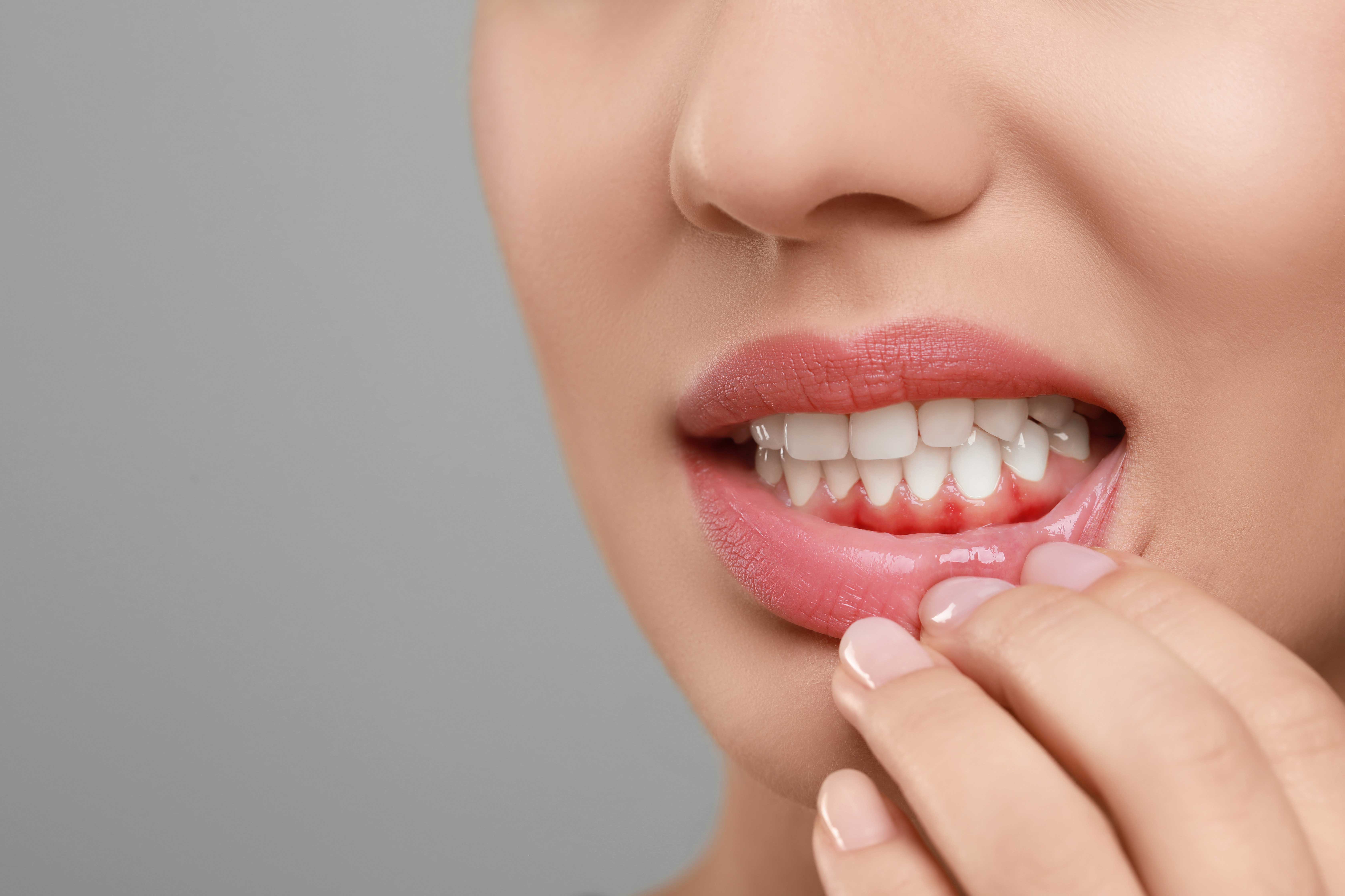 Gingivitis: Causes, Symptoms, and Treatments Banner Image Gingivitis: Causes, Symptoms, and Treatments