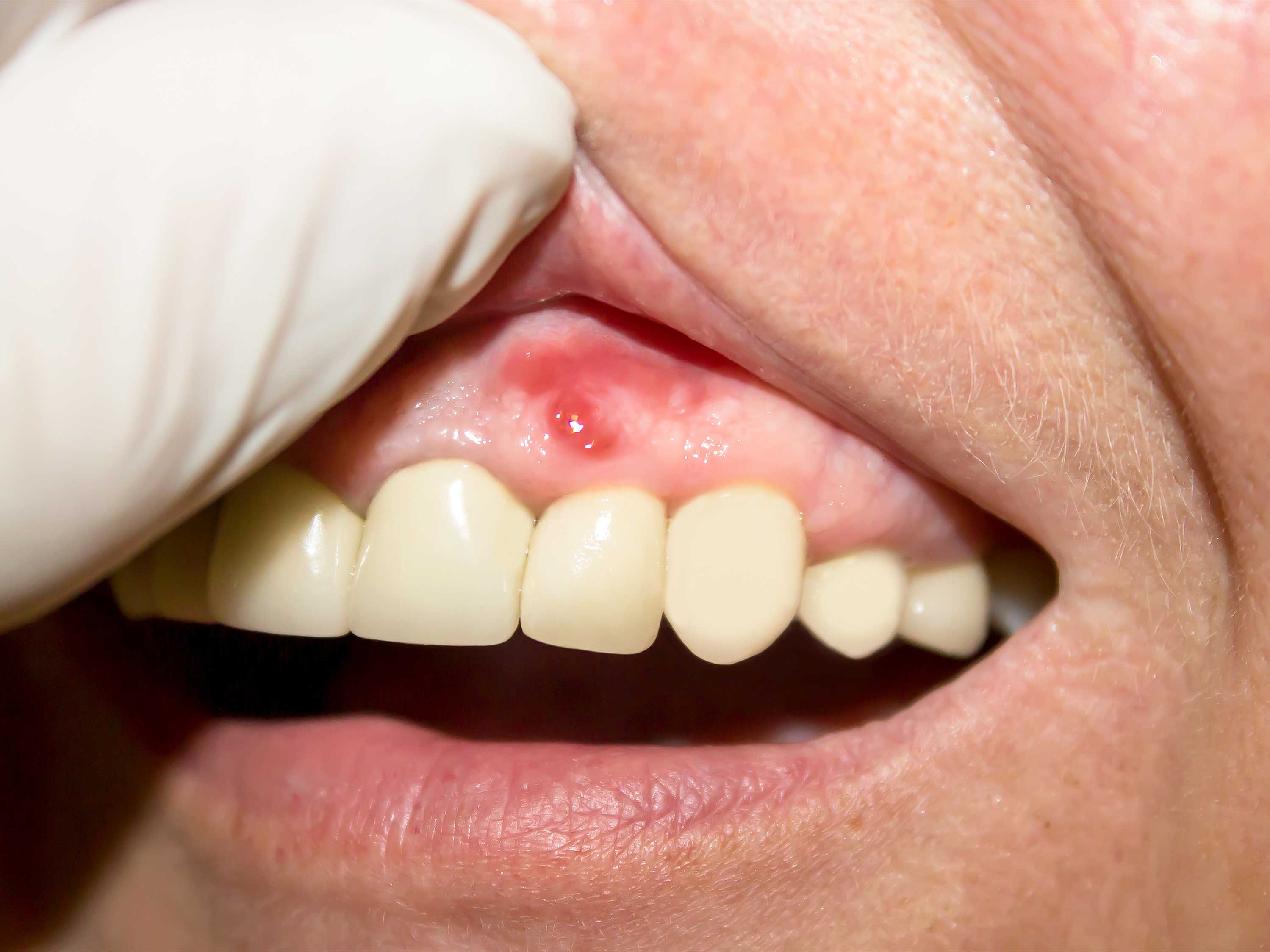 swollen-spot-on-gums-above-one-tooth.jpg