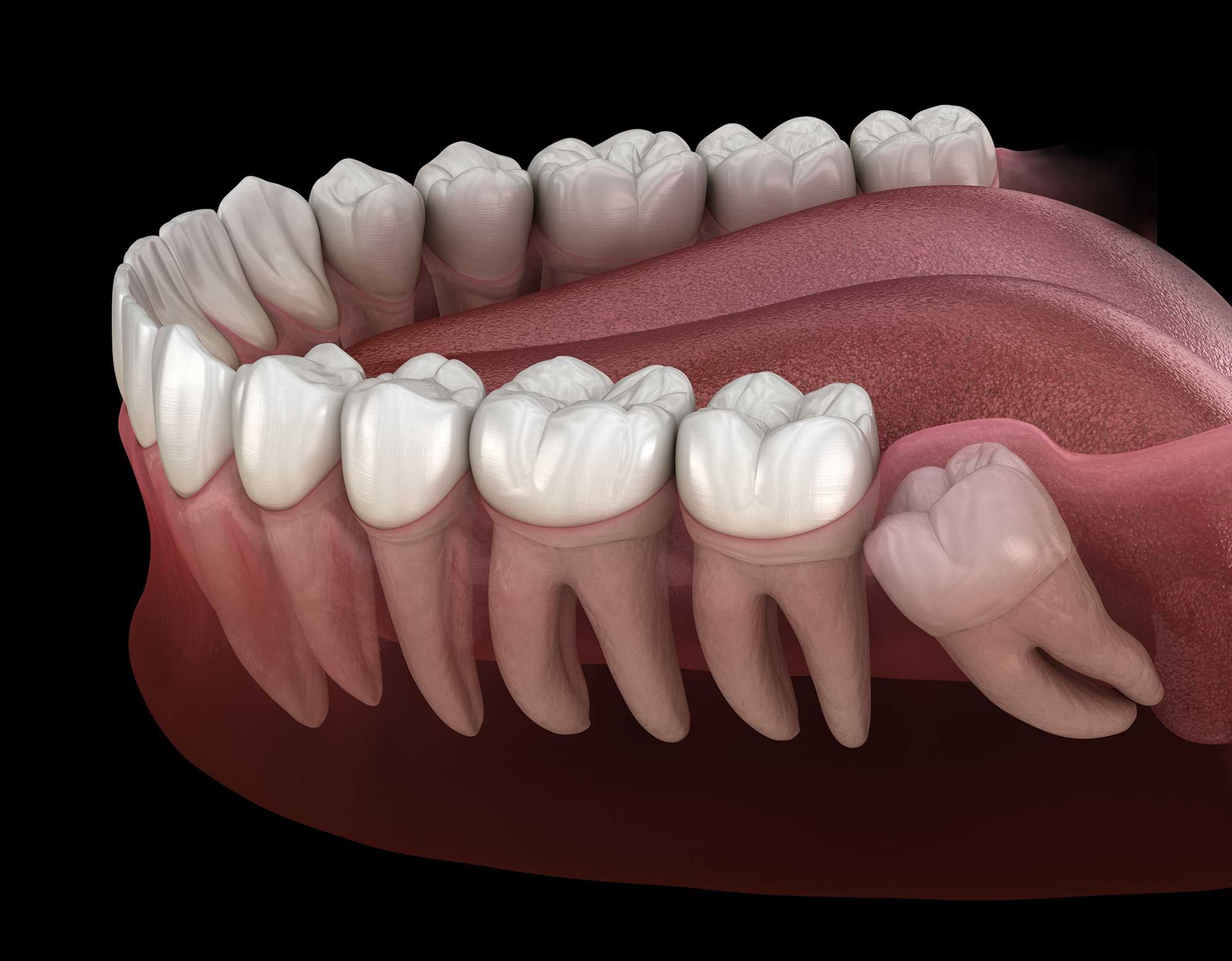 Illustration showing a wisdom tooth growing in at an angle against another tooth