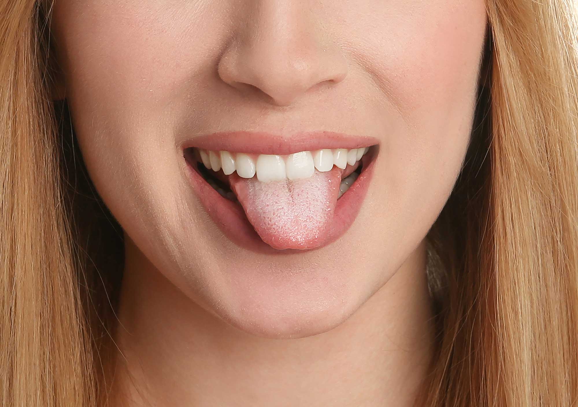 Woman sticking out her tongue with oral thrush symptoms