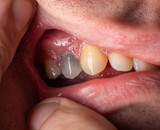 Dead Tooth: Causes, Symptoms, And Treatments