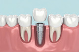 Dental Implants: The Procedure & How They Work