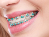 How to Pick the Best Colors for Your Braces 