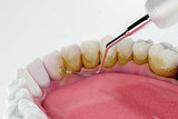 Tartar (Dental Tartar or Dental Calculus): Causes, Symptoms, and Removal