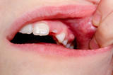 Gum Boil: Causes, Symptoms, and Treatments