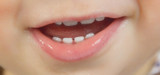 Deciduous Teeth: Eruption Timeline, Care Tips, and Their Role in Development