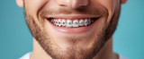 How Long Does It Take to Get Braces Put On? What To Expect