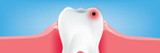What are Dental Caries? Treatments, Signs, and Symptoms