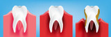 Types of Gum Disease: Stages, Factors & Related Conditions