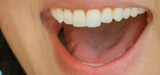 What is Geographic Tongue?