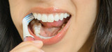 What is a Salivary Stone (Sialolithiasis)?