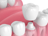 Tooth Cap Vs Crown: What's The Difference