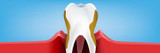 Gum Disease: Causes and Treatments