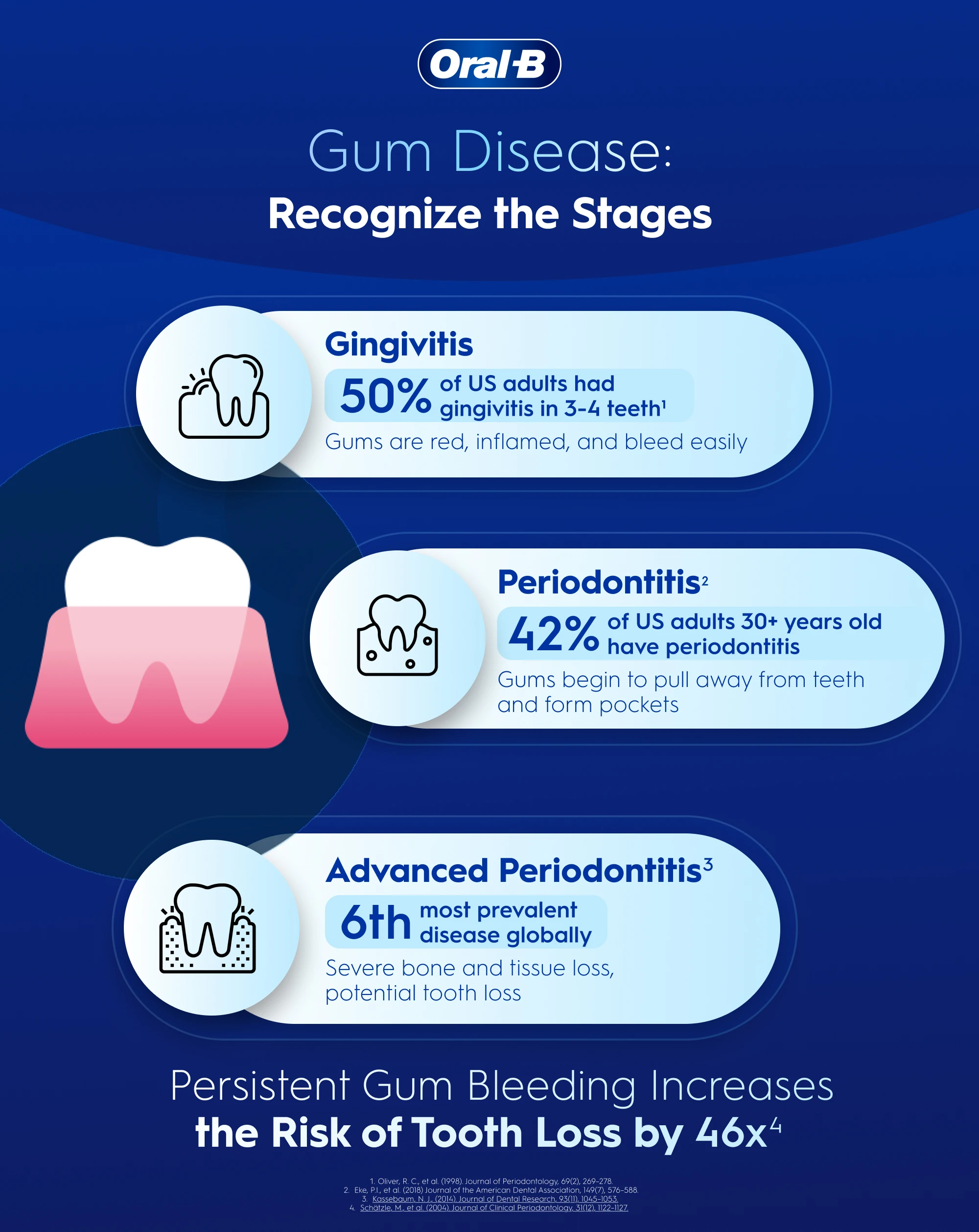 Stages of gum disease beginning with Gingivitis, Periodontitis, and Advanced Periodontitis, and a fact about gum bleeding increasing tooth loss risk
