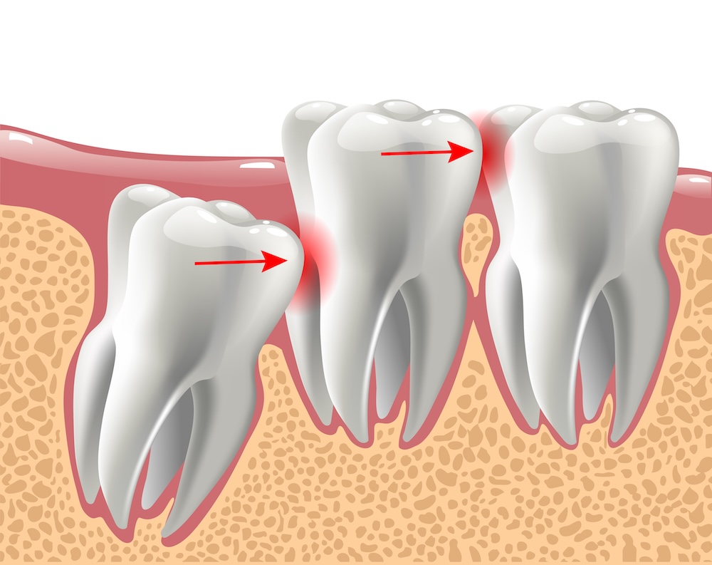 Illustration showing a wisdom tooth crowding another tooth