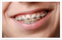 A Guide To Dental Braces: Types and How It Works - CD
